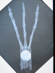 Radiographie d'une main tridactyle avec plaque métallique circulaire.